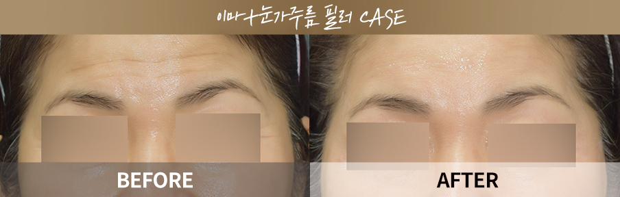 원데이리턴리프팅 시술 전후 비교 이미지 1