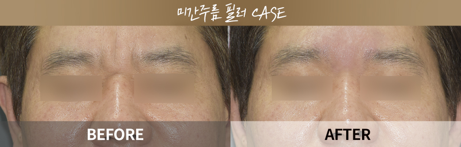 원데이리턴리프팅 시술 전후 비교 이미지 2