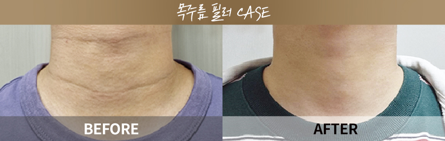 원데이리턴리프팅 시술 전후 비교 이미지 3