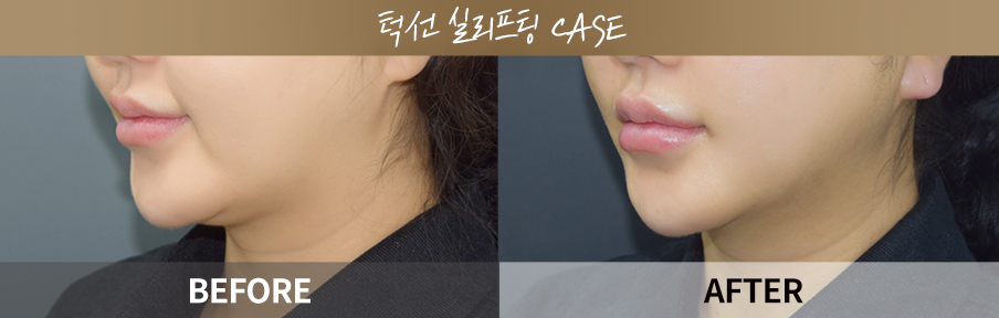 원데이리턴리프팅 시술 전후 비교 이미지 4