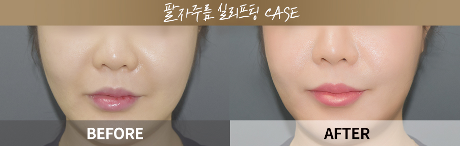 원데이리턴리프팅 시술 전후 비교 이미지 5