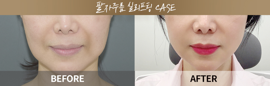 원데이리턴리프팅 시술 전후 비교 이미지 6