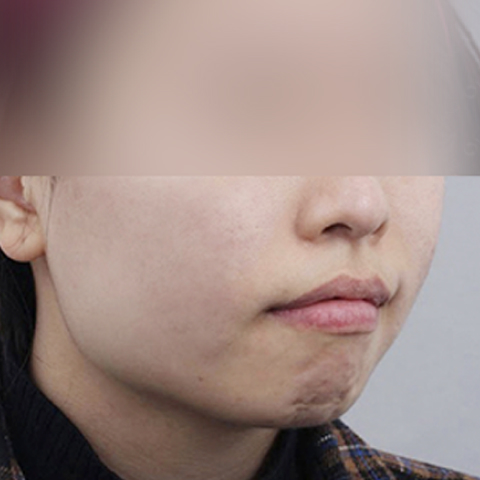 여드름 흉터케어 시술 후 모바일 이미지 1