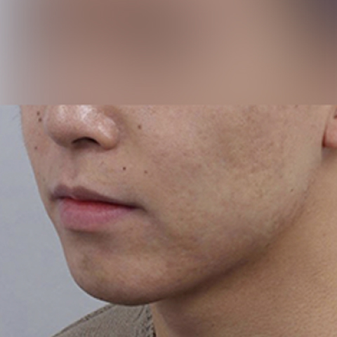 여드름 흉터케어 시술 후 모바일 이미지 2