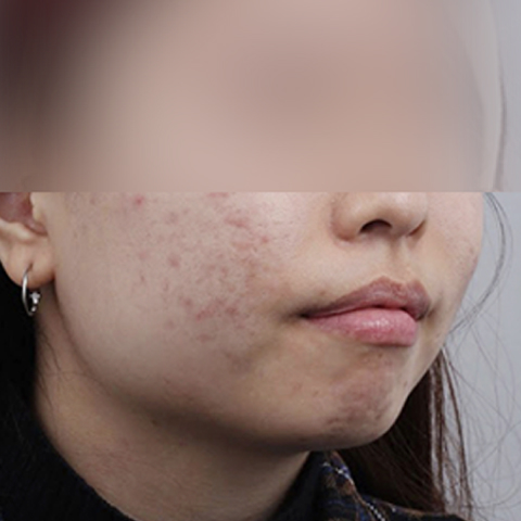 여드름 흉터케어 시술 전 모바일 이미지 1