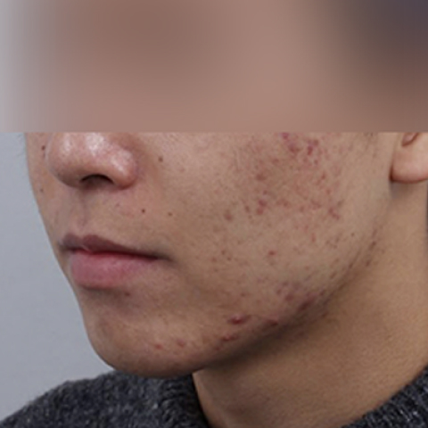 여드름 흉터케어 시술 전 모바일 이미지 2