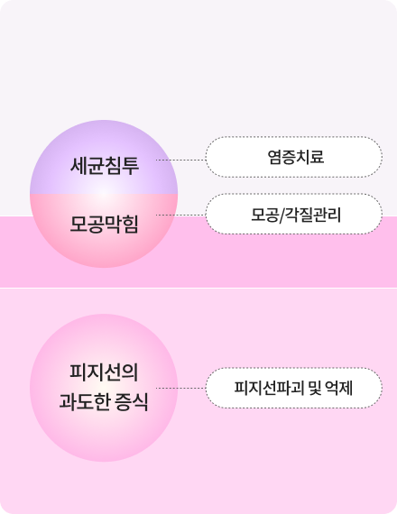 여드름 치료 시술 이미지