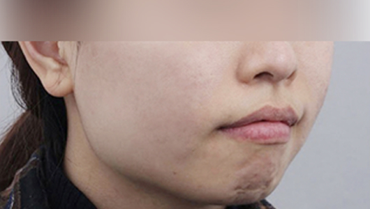여드름 흉터케어 시술 후 이미지 1