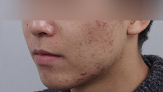 여드름 흉터케어 시술 전 이미지 2