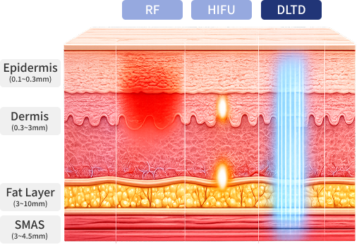 RF, HIFU, DLTD Skin Layer Target Comparison Image
