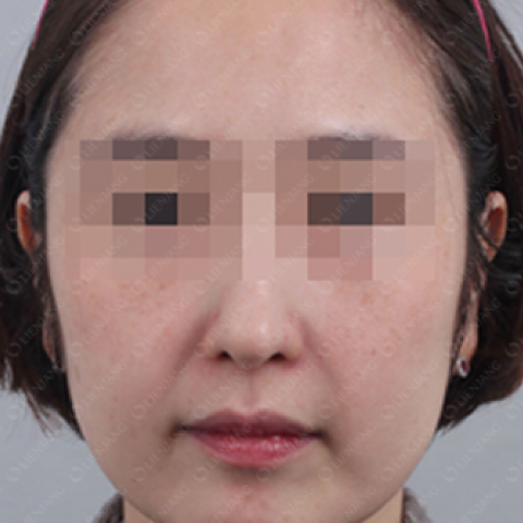 색소미백 시술 후 모바일 이미지 1