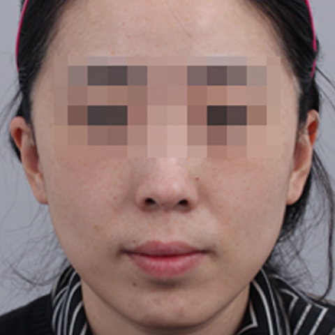 색소미백 시술 후 모바일 이미지 2