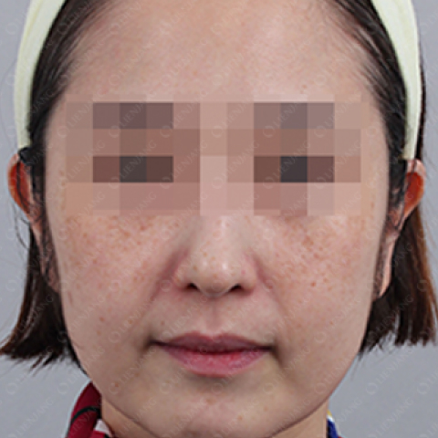 색소미백 시술 전 모바일 이미지 1