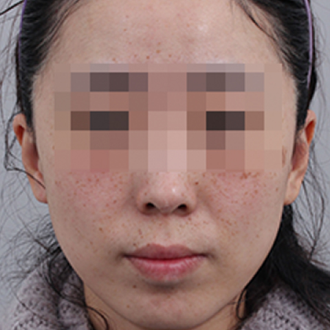 색소미백 시술 전 모바일 이미지 2