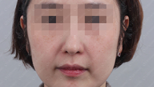 색소미백 시술 후 이미지 1