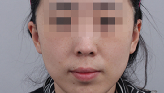 색소미백 시술 후 이미지 2