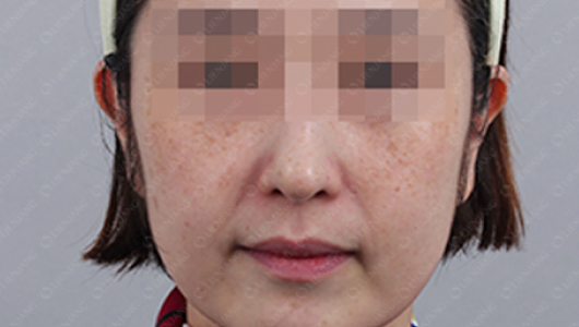 색소미백 시술 전 이미지 1