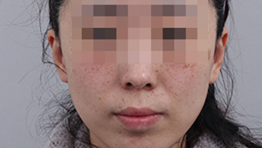 색소미백 시술 전 이미지 2