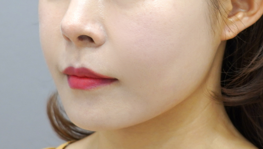 쿨페이즈 시술 3회차 후 이미지 4