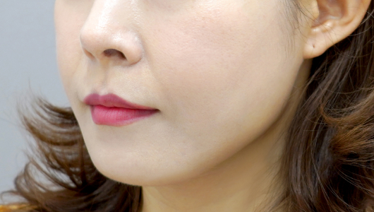 쿨페이즈 시술 전 이미지 4