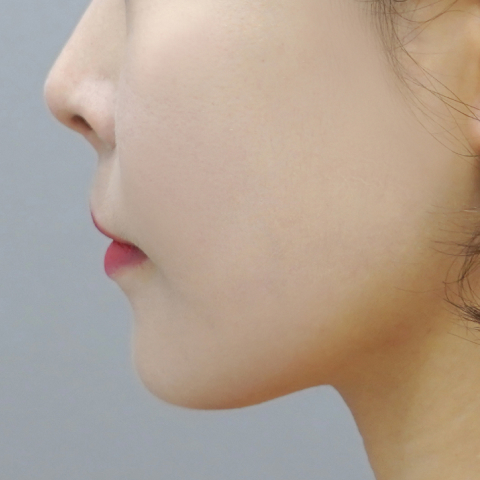 쿨페이즈 모바일 시술 3회차 후 이미지 3