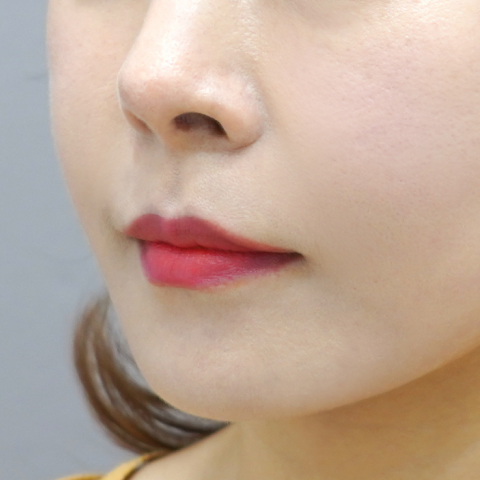 쿨페이즈 모바일 시술 3회차 후 이미지 4