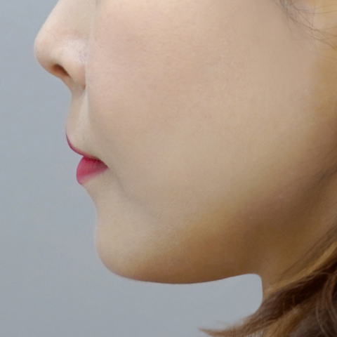 쿨페이즈 모바일 시술 전 이미지 3