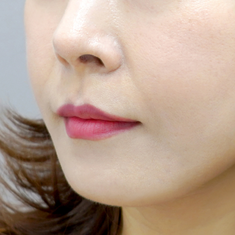 쿨페이즈 모바일 시술 전 이미지 4