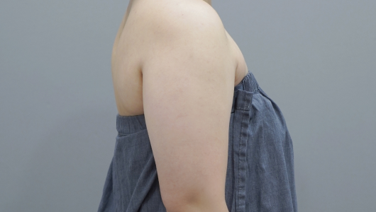온다 리프팅 바디라인 시술 전 이미지 2
