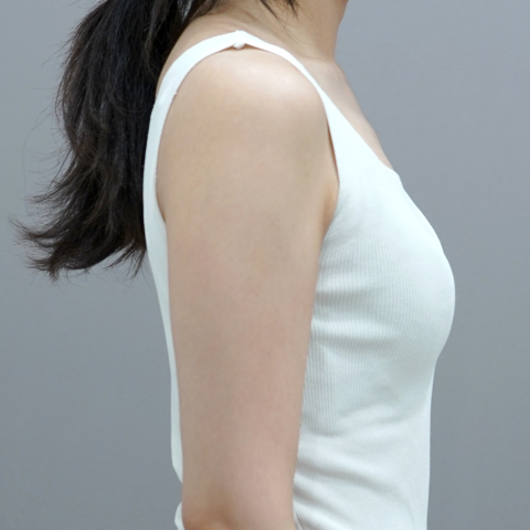 모바일 온다 리프팅 바디라인 시술 직후 이미지 1