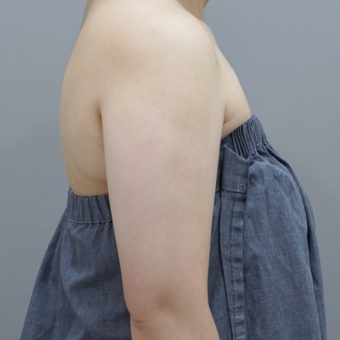 모바일 온다 리프팅 바디라인 시술 직후 이미지 2