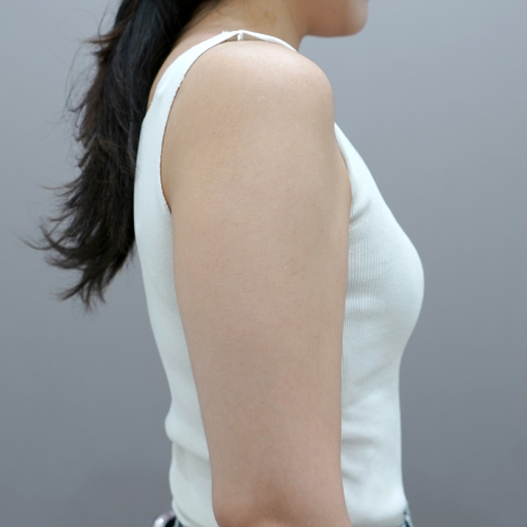모바일 온다 리프팅 바디라인 시술 전 이미지 1