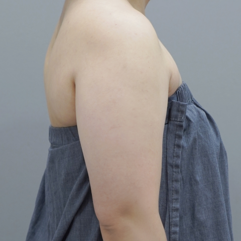 모바일 온다 리프팅 바디라인 시술 전 이미지 2