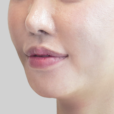 모바일 온다 리프팅 페이스라인 시술 직후 이미지 3