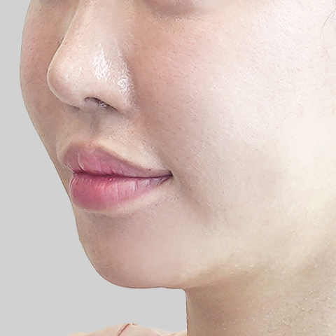 모바일 온다 리프팅 페이스라인 시술 전 이미지 3