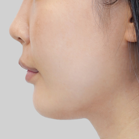 모바일 온다 리프팅 페이스라인 시술 전 이미지 6
