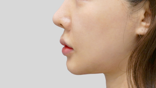 티타늄 리프팅 시술 직후 4