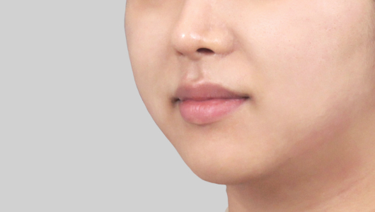 티타늄 리프팅 시술 직후 5