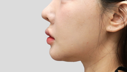 티타늄 리프팅 시술 전 4