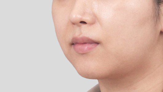 티타늄 리프팅 시술 전 5