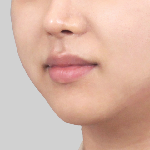 티타늄 리프팅 모바일 시술 직후 5