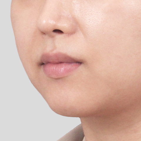 티타늄 리프팅 모바일 시술 전 5