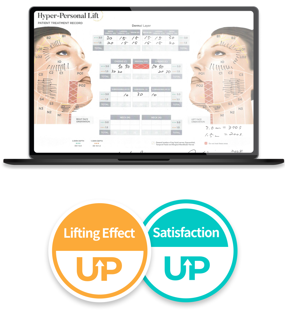 Mobile illustration of Ultherapy Prime without worry of sunken cheeks