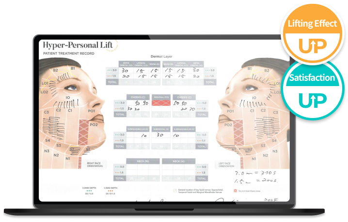 Ultherapy Prime procedure design illustration without worry of sunken cheeks