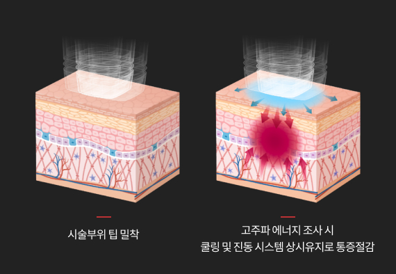 하이드로 쿨링 레벨로 통증을 줄이며 타이트닝을 유도하는 시술 효과 이미지
