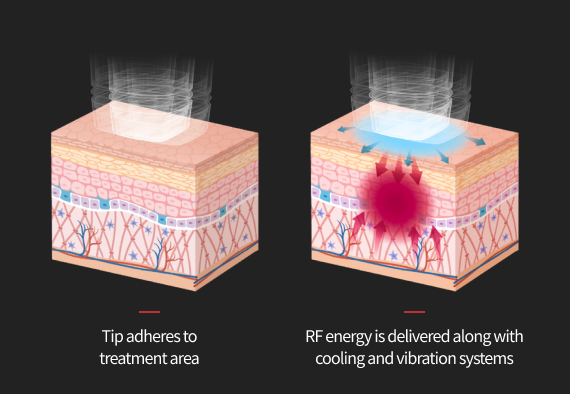 Treatment effect image inducing tightening while reducing pain with hydro cooling levels